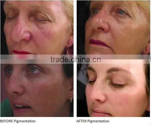 Best IPL Skin Rejuvenation/Anti Ageing ipl laser machine