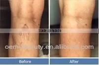 Salon equipment laser hair removal for sale