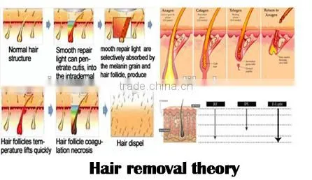 Virtue Beauty factory Alexandrite laser 755nm laser hair removal price