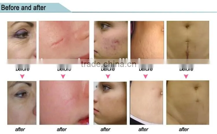 guangzhou vertical farctional co2 laser/co2 laser fractional vaginal tighten machine CE approved
