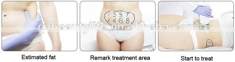 hifu slimming machine 2016