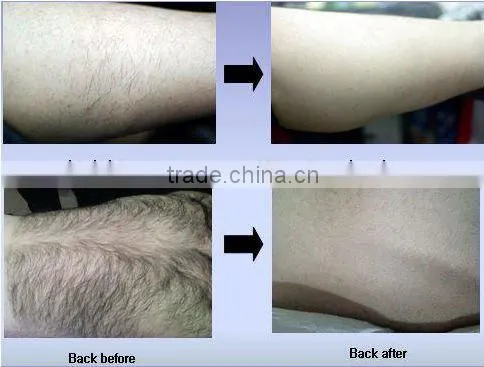 808nm diode laser portable hair removal beauty equipment portable with CE