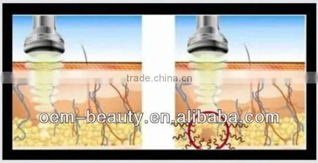 5 Treatment Head Cavitation Tripolar RF Vacuum Body Slimming Machine F019