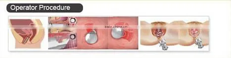 40W fractional co2 vaginal tightening laser with skin resurfacing acne treatment