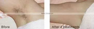 Upgrade e-light+ipl+rf facial equipment for sale