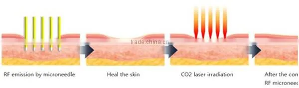 Factory direct sale! Professional skin rejuvenation/ wrinkle removal fractional rf microneedle face treatment