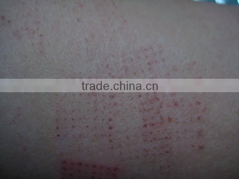 CO2 fractional scar removal laser