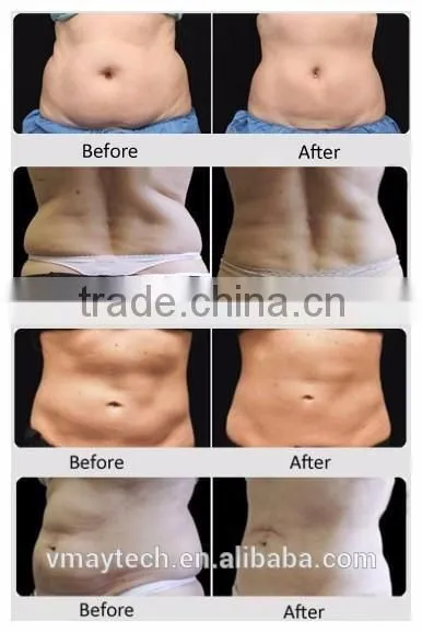 40K cavitation lipolaser multipolar RF vacuum cavitation 650nm lipolaser slimming machine for salon use VL210