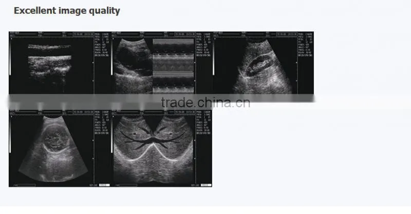 Medical Laptop B mode Ultrasound Scanner RUS-2200 USB 2.0 optional Biopsy Brackets