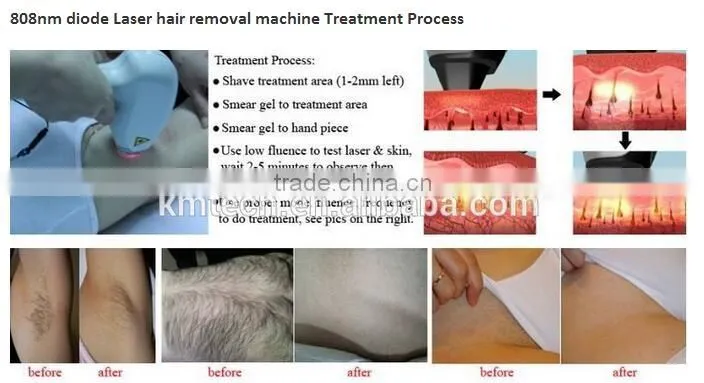 Fast delivery best China diode laser hair removal medical device