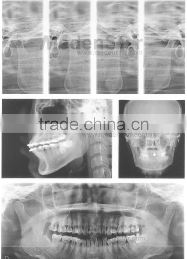 Dental Supply Digital Panoramic X-Ray Dental Unit with Cephalometry XR-90