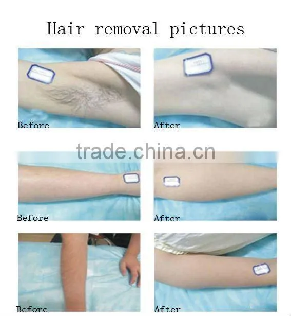 808nm Diode Laser Encounter Smooth Skin 2012
