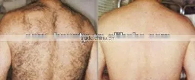 nd yag laser hair removal long pulse laser Skin Rejuvenation equipment