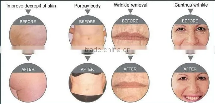 AYJ-T05 ayplus best home rf skin tightening face lifting machine