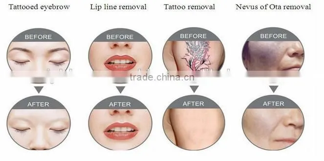 Professional salon use q switch nd yag diode laser tattoo removal