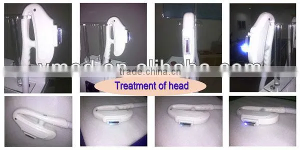 Hair loss Near Hongkong/Hot hair removal IPL +RF