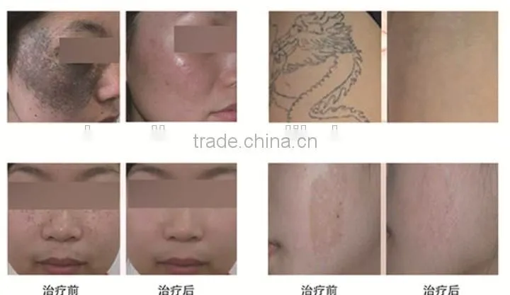 1064nm laser tattoo removal machine fda approved laser alexandrite laser hair removal machine