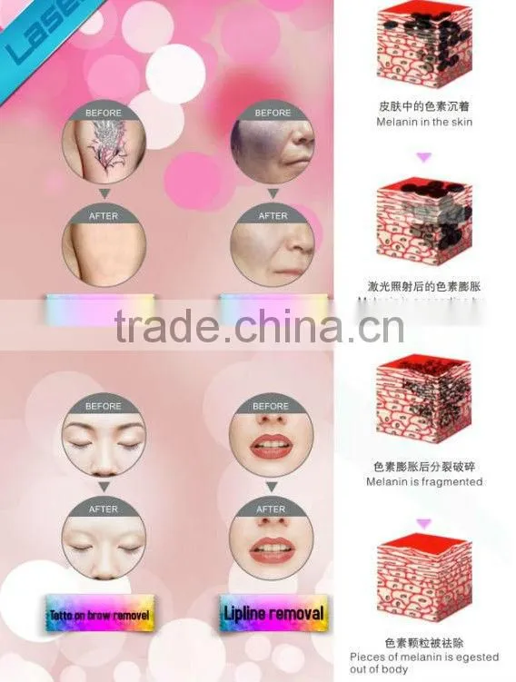 nd yag laser dark skin tattoo removal/mini q switched nd yag laser tattoo removal machin/nd yag laser