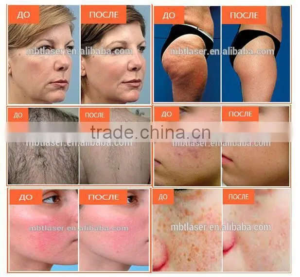 2016 New Hottest!!! Brighter shopping Through hole shr opt ipl shr hair removal machine with GOST-P