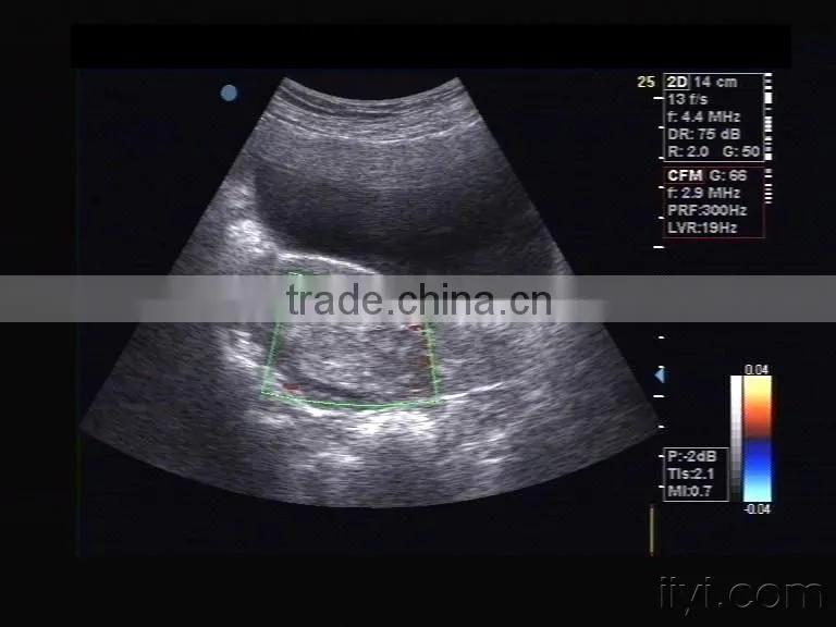 CE approved PC Portable Ultrasound Scanner with 3.5Mhz multi-frequency convex probe RUS-9000A