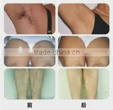 1064nm light sheer diode laser hair removal machine