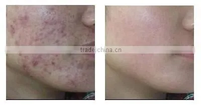 2014 latest laser acne scars REMOVAL non-ablative fractional laser