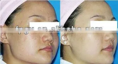 Professional Skin Rejuvenation and Hair Removal IPL Beauty Equiment
