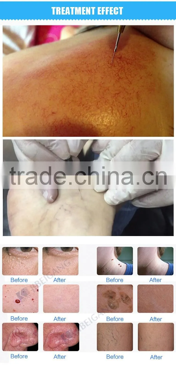 New arrival best treatment portable painless blood vessel removal laser home remedies for spider varicose veins removal machine