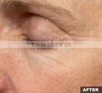 Hot Fractional & Micro needle RF machine wrinkle removal, face lifting/fractional microneedle radiofrequency