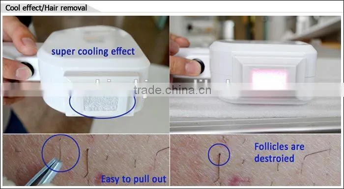 Hot selling TEC cooling system stationary 808nm diode laser hair removal depilador laser epila