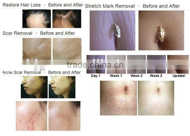 latest RF machine,rofessional Wrinkle Removal,Face Lift ,Partial slimming machine Bi-polar RF beauty machine(CE approved)