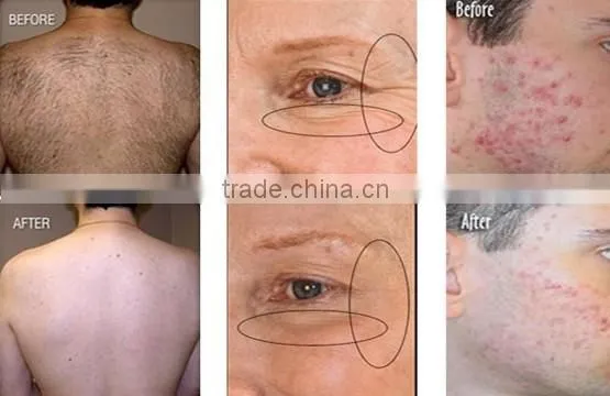 SHR IPL Elight Acne Scar Removal Machine/ Home Permanent Hair Removal