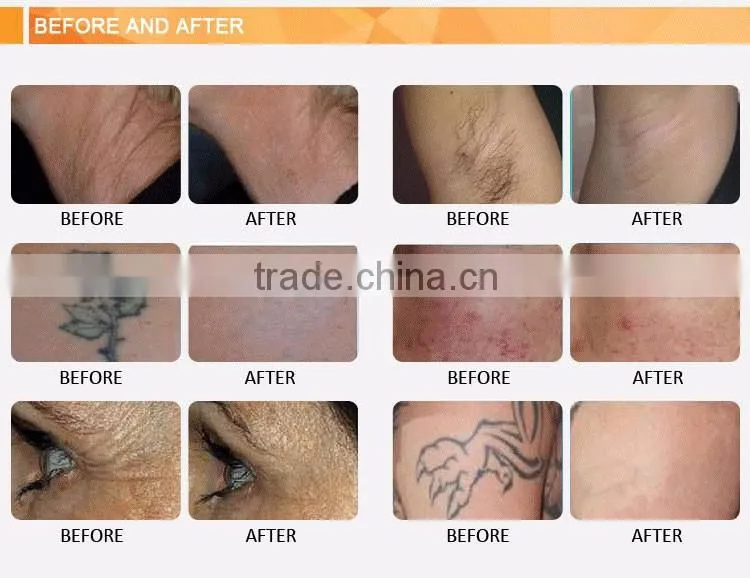 Promotion high frequency ipl handle home laser hair removal machine for acne treatment
