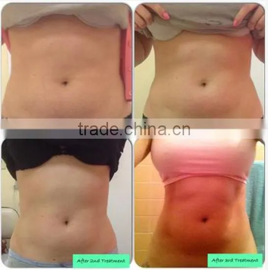 NL-LSR900 Laser ultrasonic cavitation body slimming machine with Bipolar Tripolar RF and 650 nm Laser for fat burning body slim