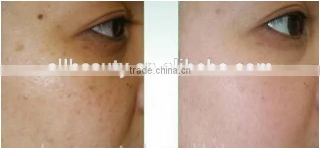 CO2 fractional beauty for facial resurfacing machine