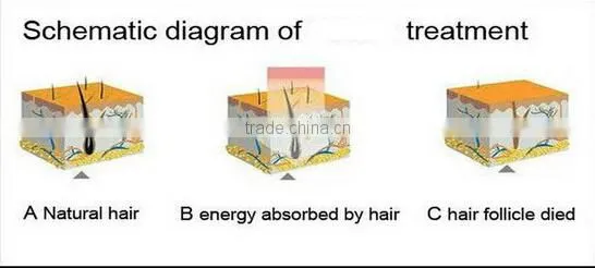 Aroma epilator laser hair removal machine diode
