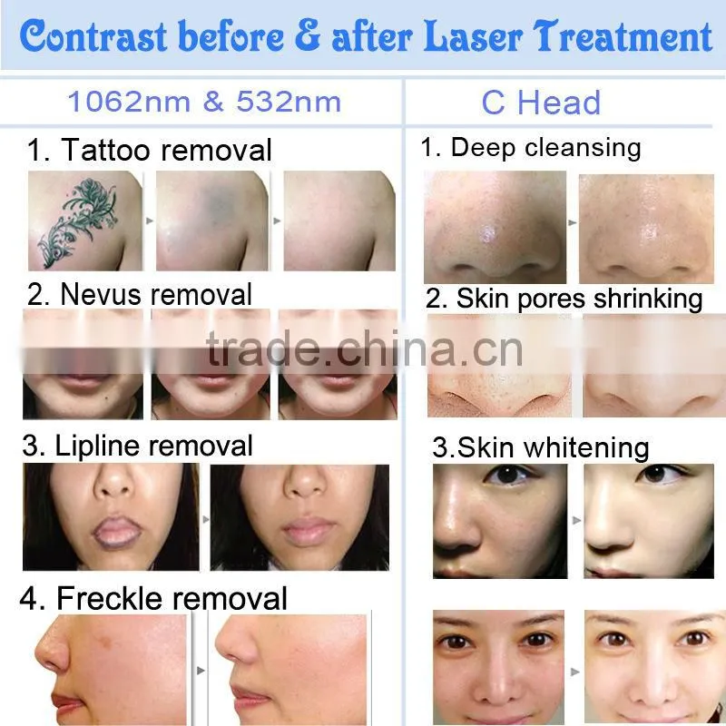 Hot Sale CE Q-Switch Nd Yag Laser Pigment/Tattoo Removal System Home Use