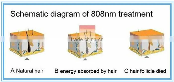 wholesale permanent painless hair removal machine 808nm diode laser hair removal