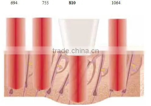 Nice design Laser machine 808nm diode laser hair removal machine