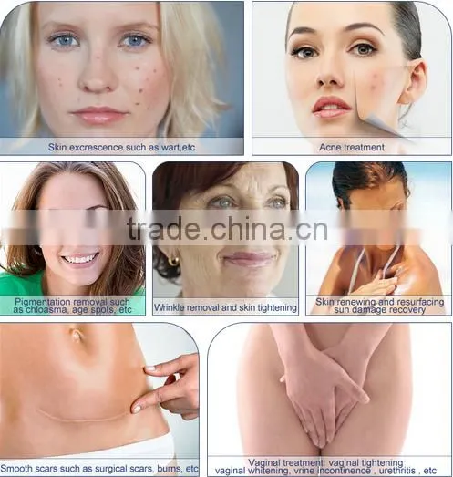 CO2 Fractional Laser Scar removal skin resurfacing fractional co2 laser equipment