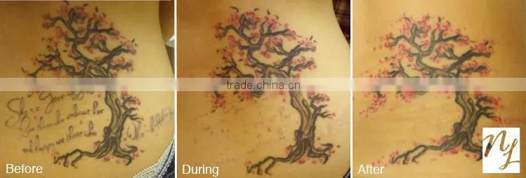 Tattoo Removal Laser Nd Yag Laser