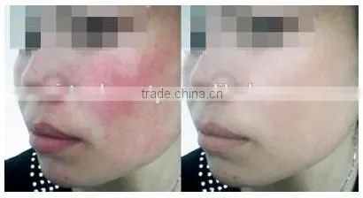 CE approval led pdt acne treatment beauty machine