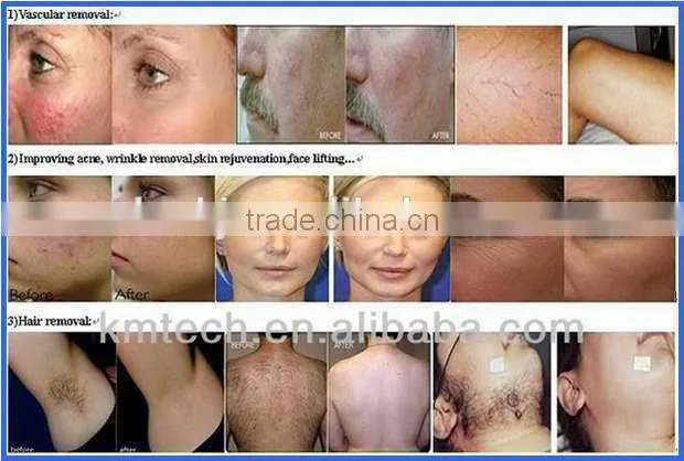 Most popular and top sale elight machine with CE certificate