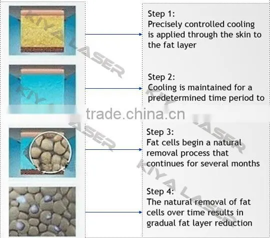 2016 most popular freezing fat procedure