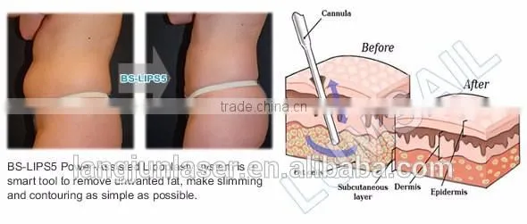 Weight Loss liposuction machine for body shaping