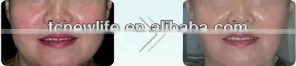 NL-TM800 High qualtiy face lift device thermagic cpt/thermagic rf machine