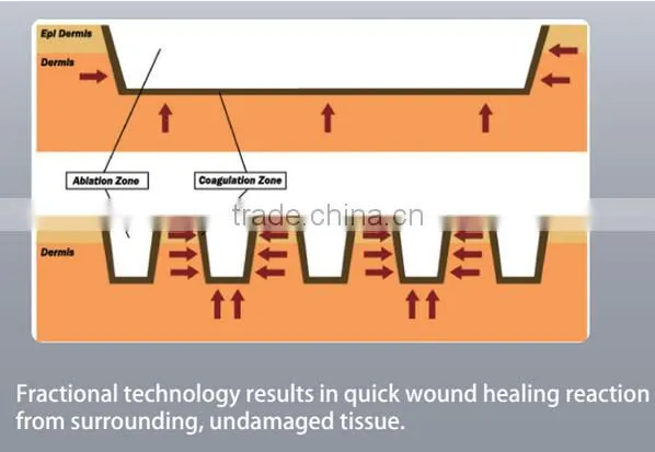 thermagic machine for home use, best rf skin tightening face lifting machine, fractional rf microneedle, thermagic