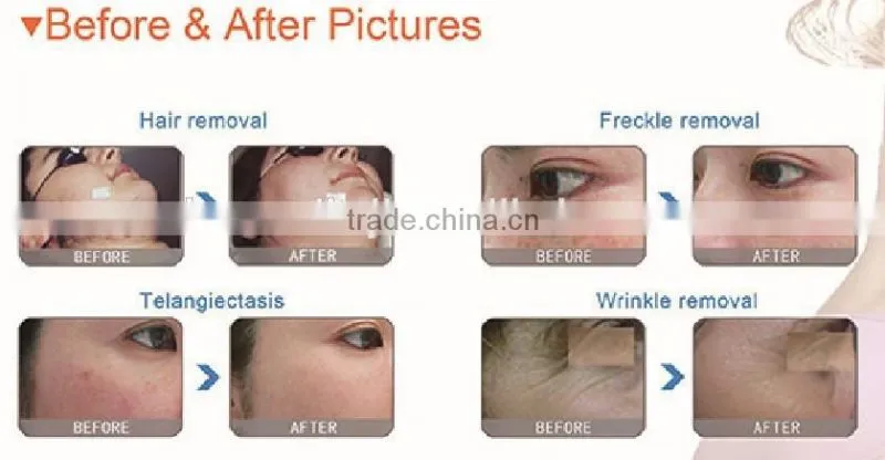 Hot sale Portable Elight&IPL&RF Hair Removal Equipment, SHR beauty care machine