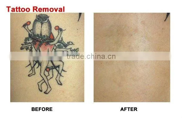 Germany lamp Nd: YAG Laser tattoo removal 1064/532/1320nm