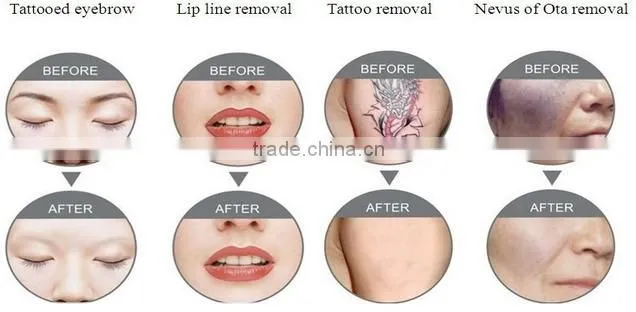 Cheapest 2014 !!!! popular q switch nd yag laser cream tattoo removal